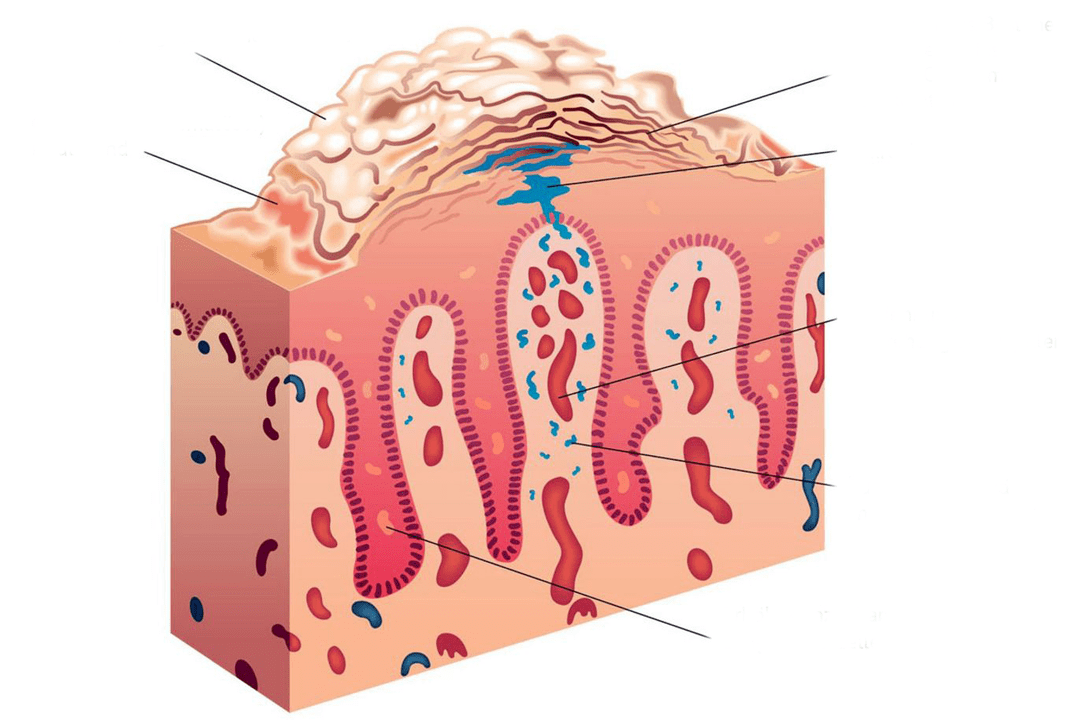 secção transversal da pele na psoríase