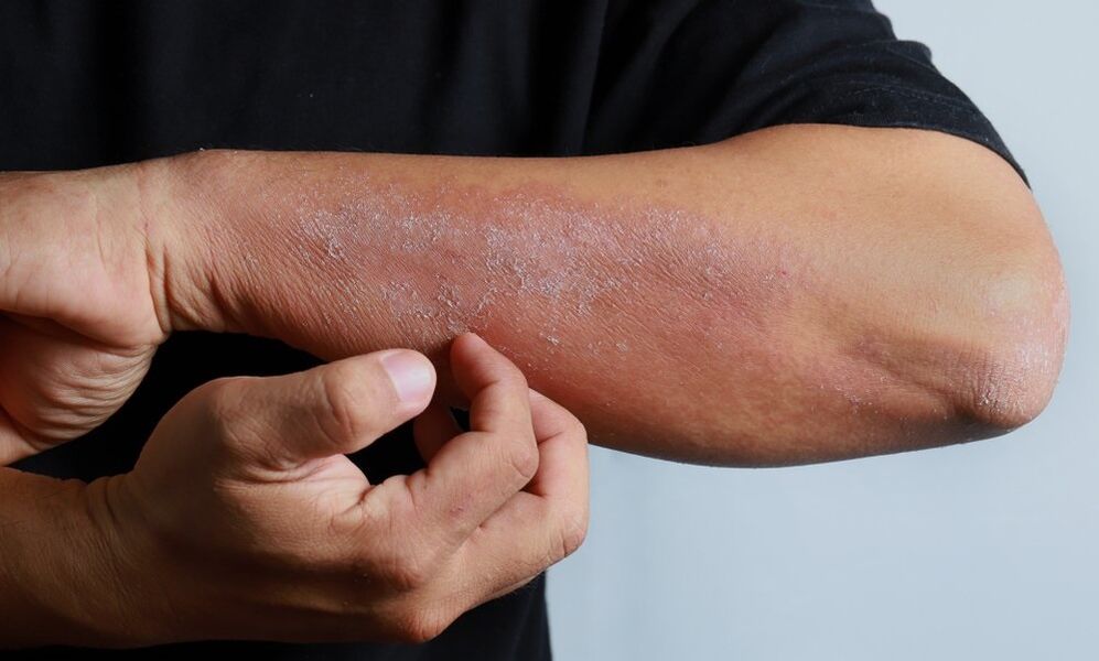 sintomas de psoríase no braço